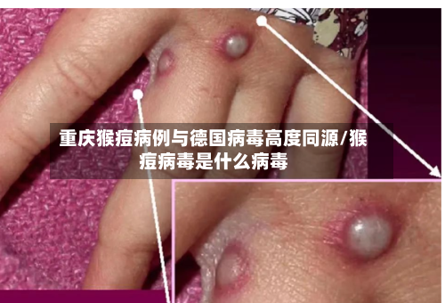重庆猴痘病例与德国病毒高度同源/猴痘病毒是什么病毒